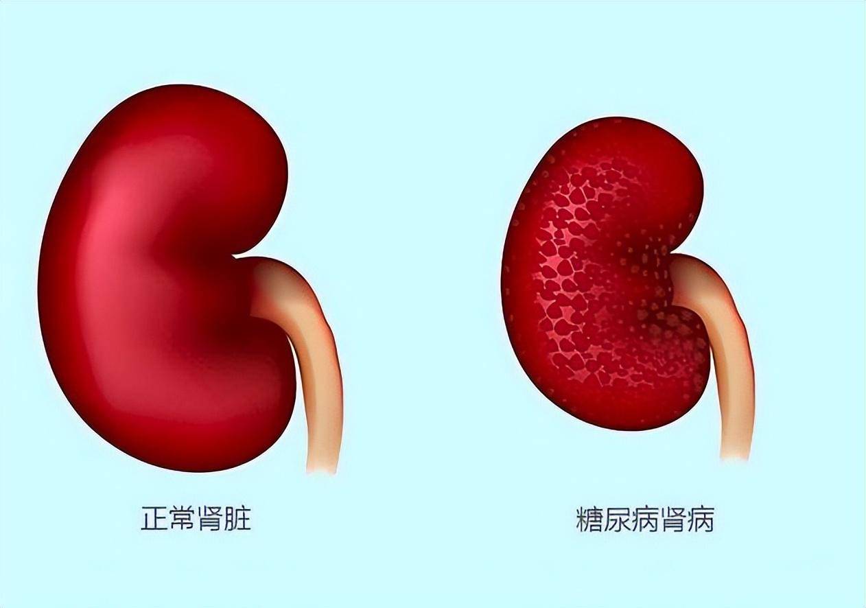 11种糖尿病并发症你知道吗?出现14个症状要重视!