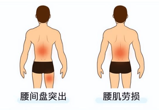 肌纖維和筋膜在自我修復中,容易產生瘀痕和粘連,加之扭傷伴隨的疼痛