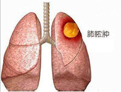 肺部有病变,痰液会先"通知"你:若咳出6种痰液,建议早筛查_呼吸道_红