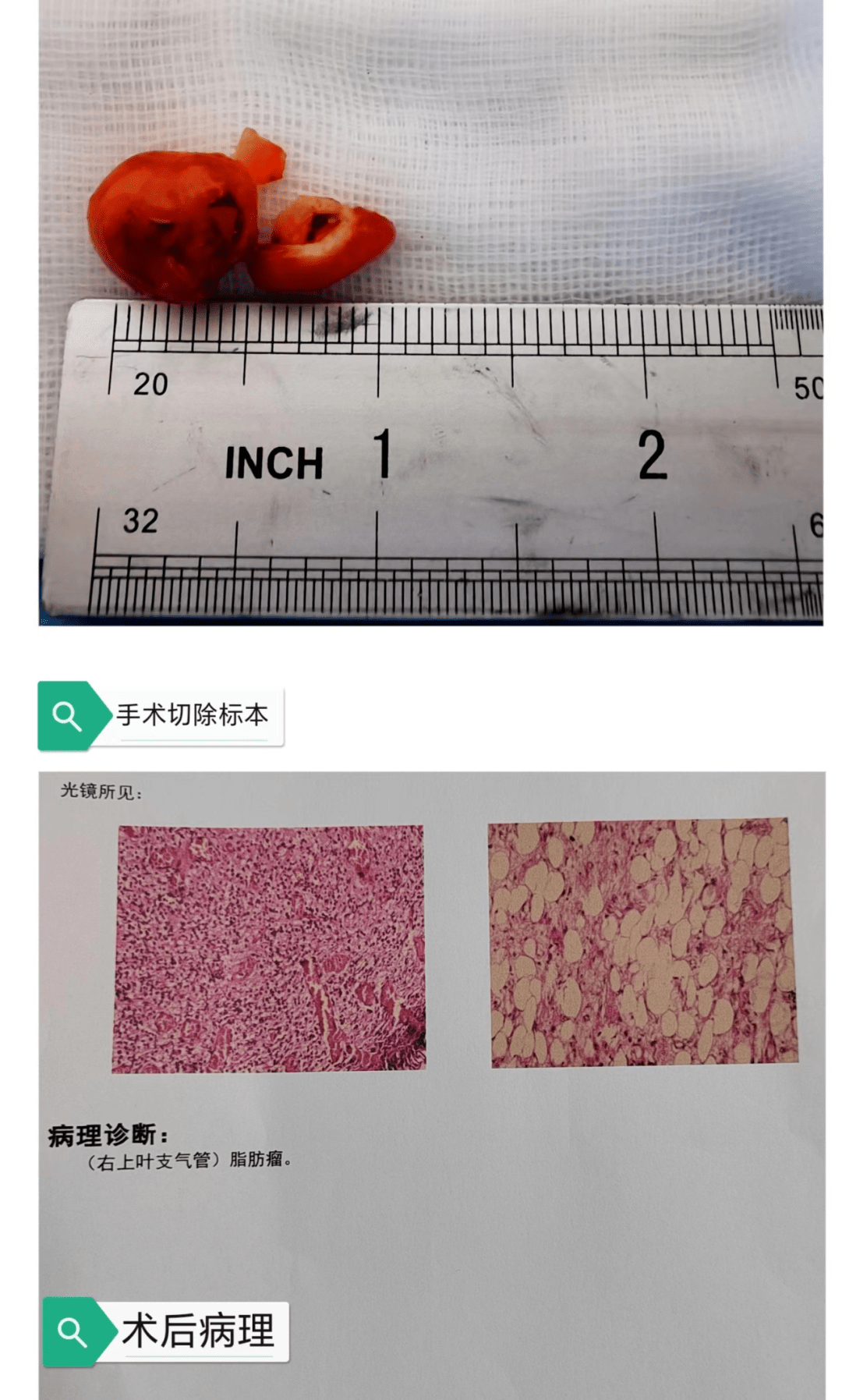 病理报告单 肿瘤图片