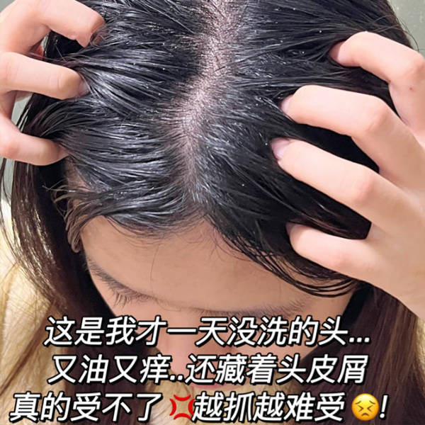 疑惑:头皮屑为何如此纷飞?解答:仔细检查清洁方法._去屑_问题_头发