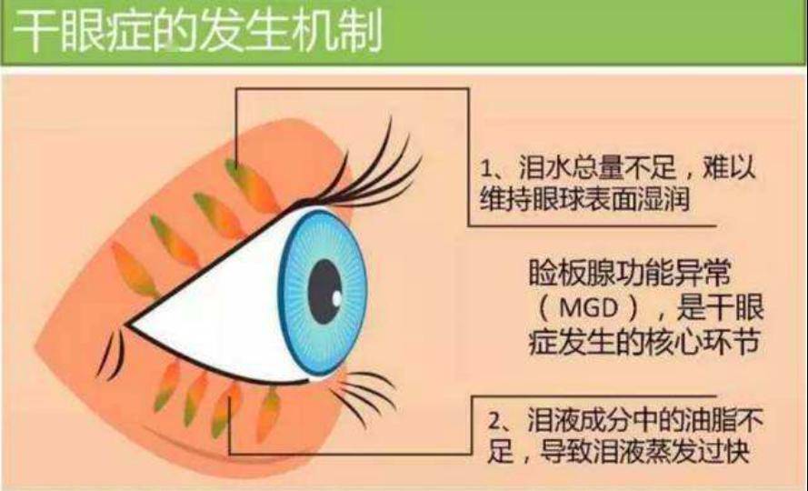 眼睛干涩不适怎么办听听专家怎么说