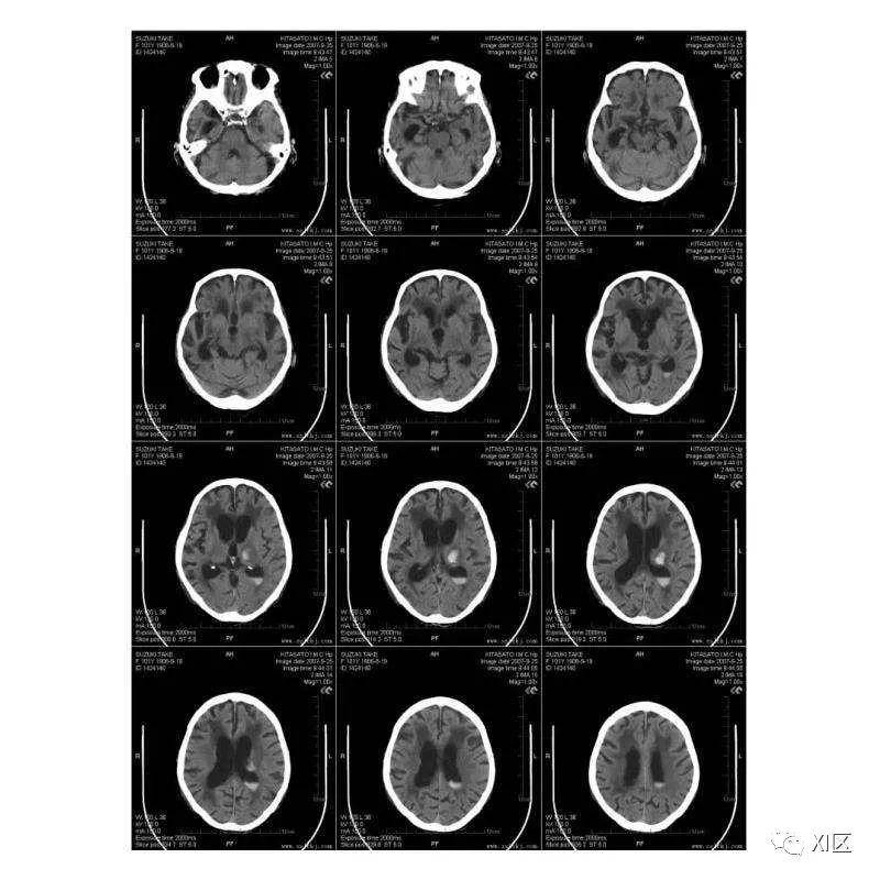 ct胶片上哪些参数和剂量有关?