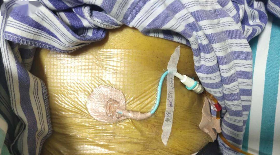 除ptcd术,目前我院超声科已经成功开展甲状腺穿刺(fna),浅表肿块穿刺