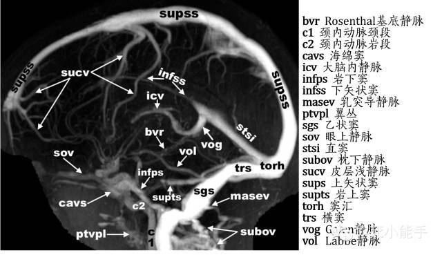 头颅静脉解剖图mrv图片