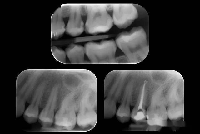 继发龋x片图片