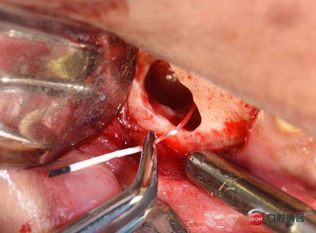 从微创到精准后牙根尖囊肿摘除根管倒充填手术