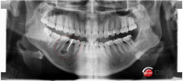 可谓经历了牙病之苦,当时未引起足够的重视,从牙髓炎到根尖炎以至于到