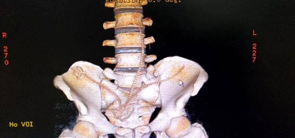 一位患者因为从肛门塞入三条泥鳅而就诊,ct三维重建下三条泥鳅的骨骼