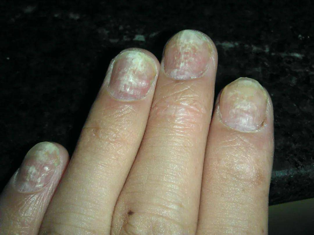 灰指甲医学上称为甲癣,甲真菌病,是由皮肤真菌侵犯指(趾)甲所引起的