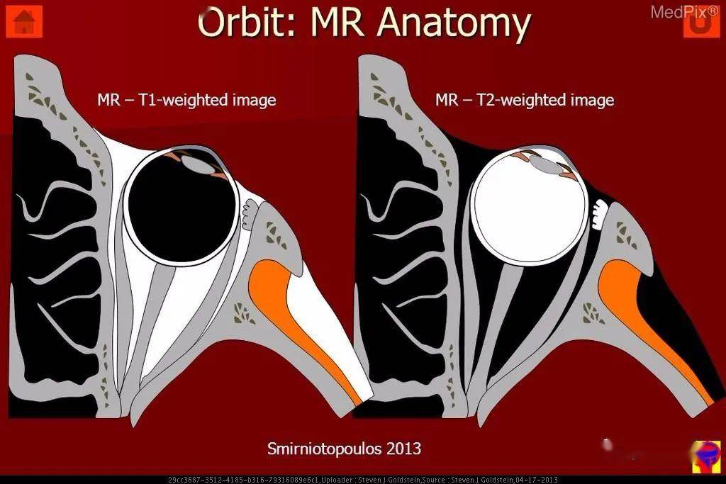 鉴别丨视网膜脱离脉络膜脱离玻璃体后脱离