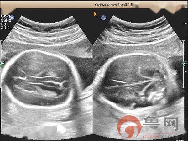 枣庄市妇幼保健院超声科诊断出一例胎儿开放性脊柱裂