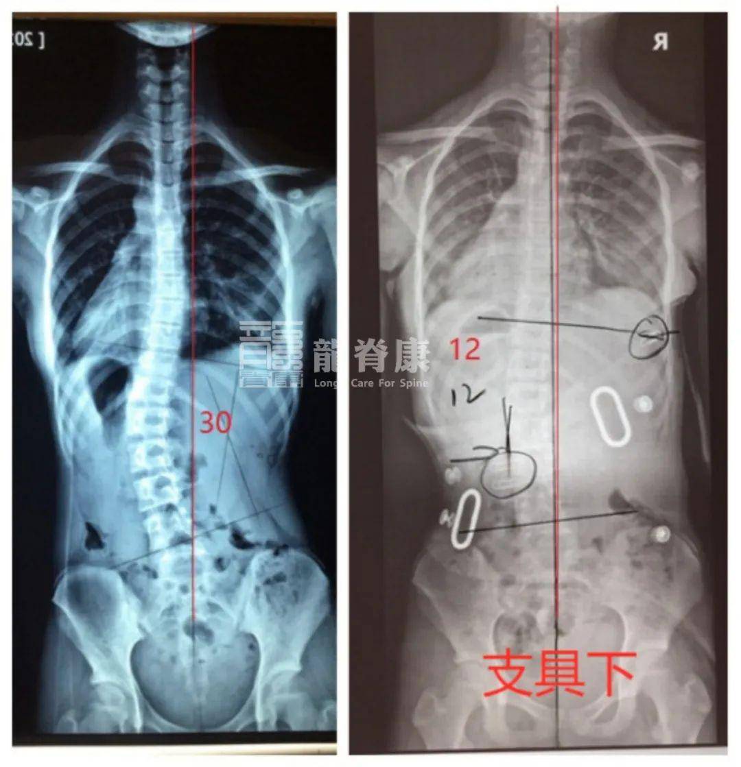 2019年时由于体态不佳,于外院拍x光片检查诊断为脊柱侧弯已经高达30