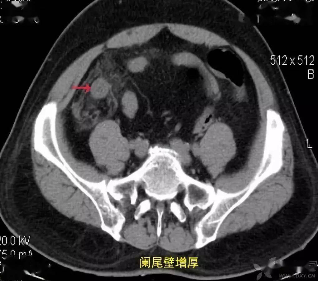 急性闌尾炎 ct 診斷