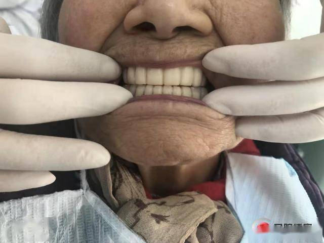 全口义齿重做技巧