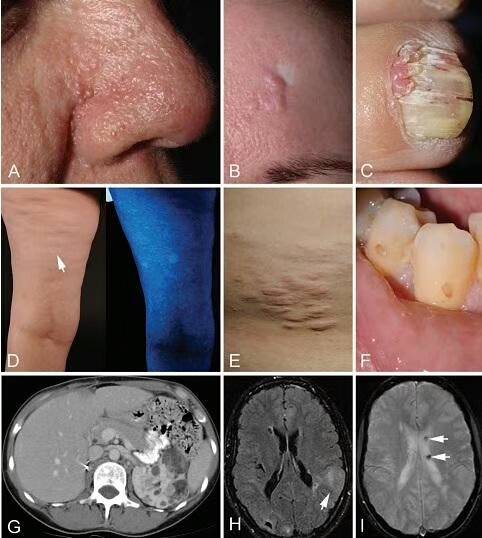 非创伤性指(趾)甲或甲周纤维瘤;色素脱失斑(≥3处);鲨革样皮疹(结缔