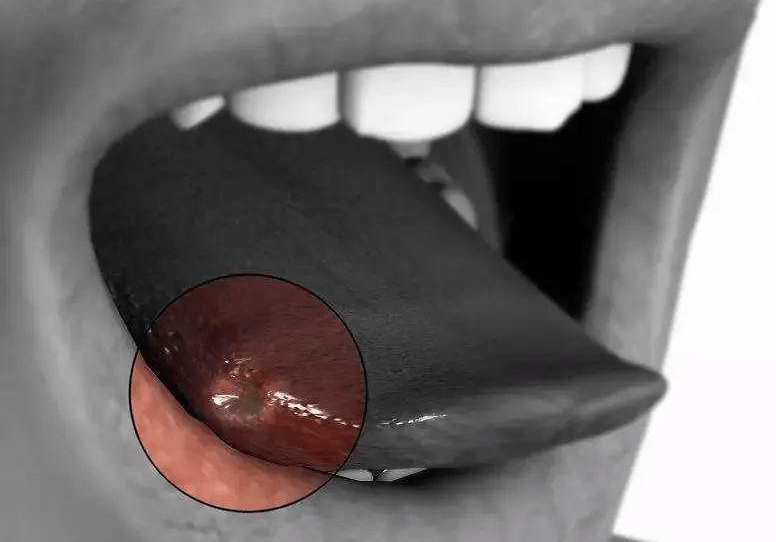 口腔癌的照片图片