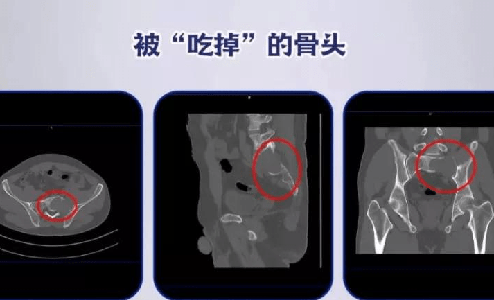 多发性骨髓瘤有哪些典型症状参考螃蟹症