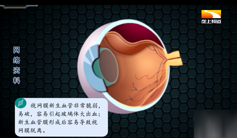 糖尿病視網膜病變有哪些類型?武漢普瑞眼科醫院許澤駿為您解答