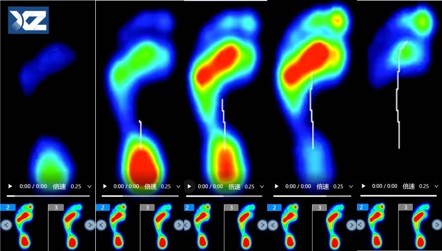 压力测量能揭示马蹄足,高弓足,扁平足等足部畸形的足底压力分布规律