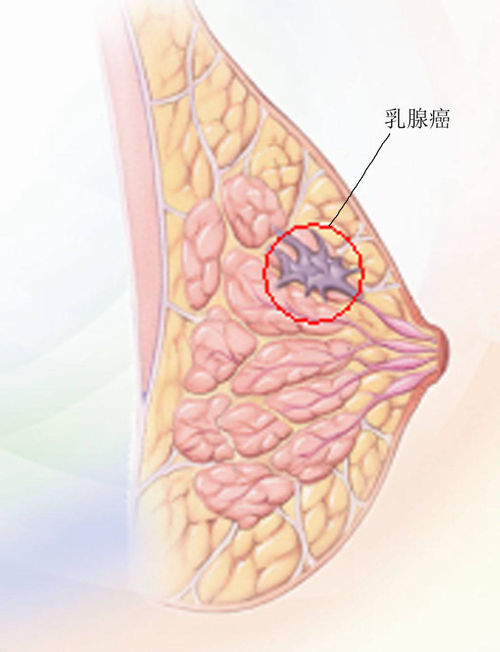 乳房结节图片症状图片