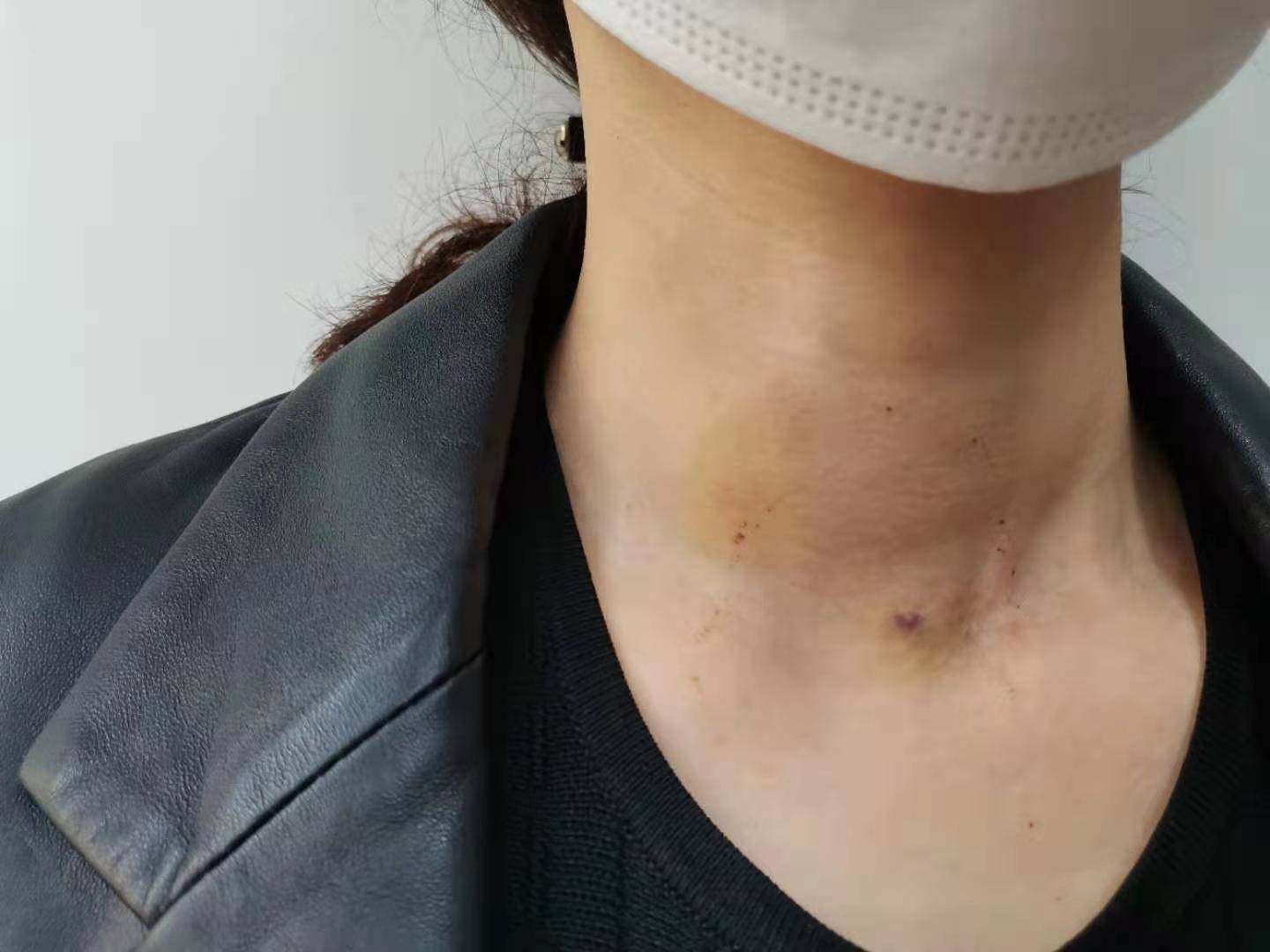 食欲减退还发胖,甲减到底是什么?