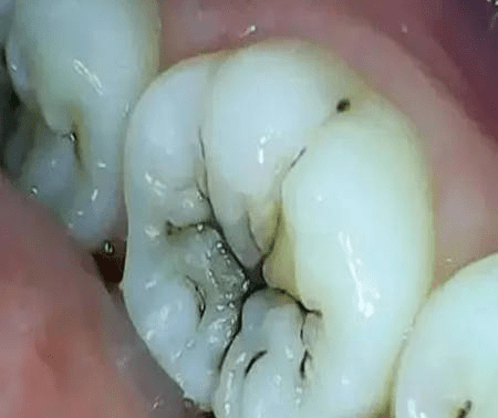 牙齿咬合面有黑线,大牙一般最常见,说明开始蛀牙了,牙釉质被细菌龋坏