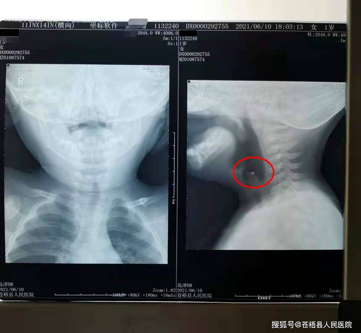 取物救宝苍梧县人民医院耳鼻喉科成功抢救一名喉部异物患儿