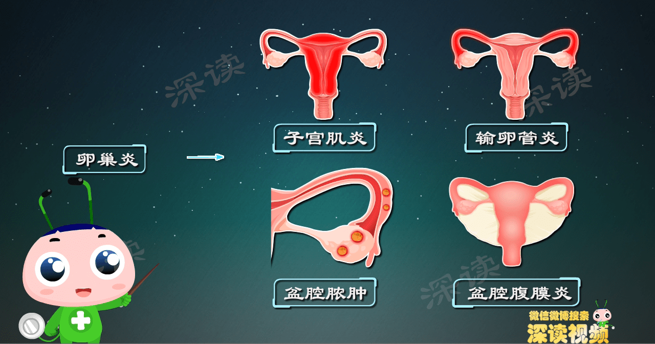 育齡期女性易發卵巢炎卵巢炎咋回事動漫揭秘卵巢炎發病機制燃