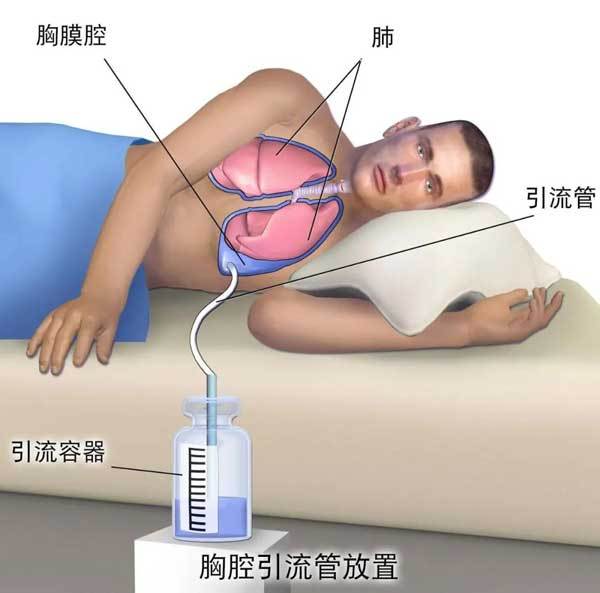 什么是导管引流 8b2f0dcbd917435ab5b4d4e1efabfb23.jpeg