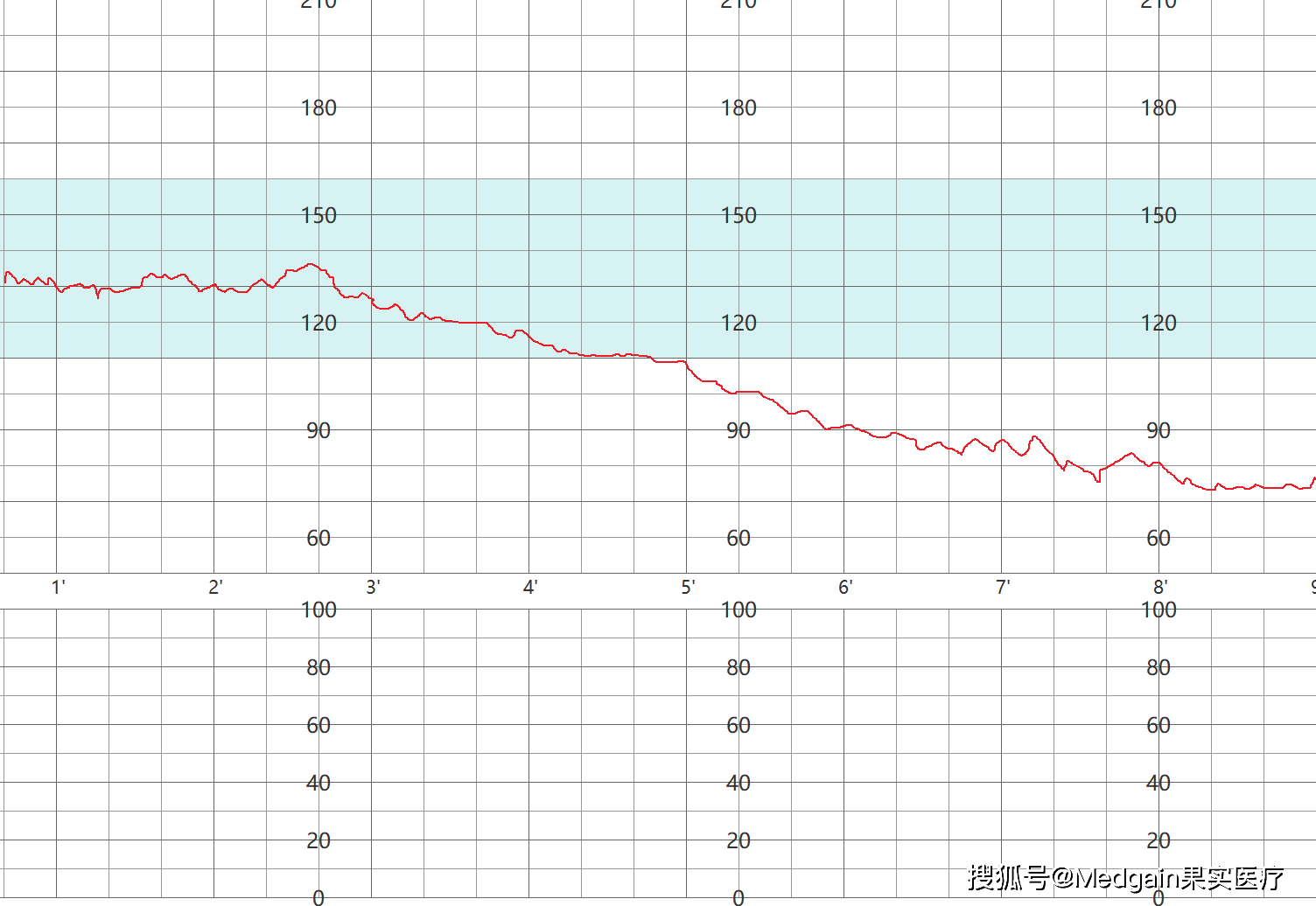 胎心監護過程中出現的終末減速圖型在胎兒即將娩出時,由於臍帶及胎頭