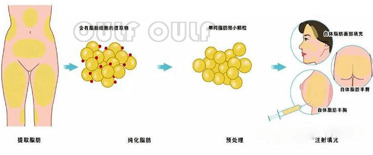 注入|填充太阳血后脸看着圆