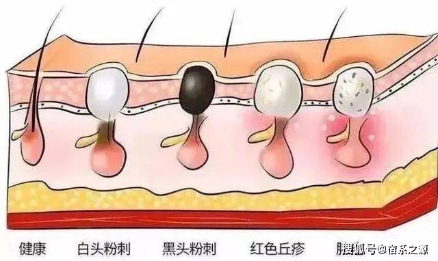 角栓|毛孔会呼吸了！宿系之源和你一起来个去黑头大作战！