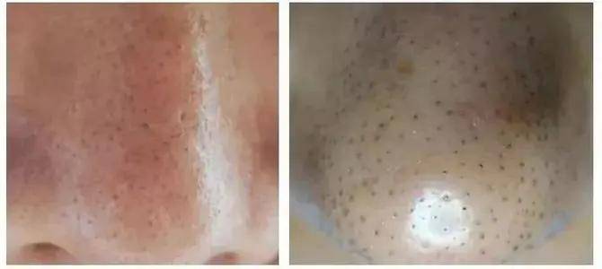 方法|最火的几种去黑头的方法，求求你千万不要再做了！