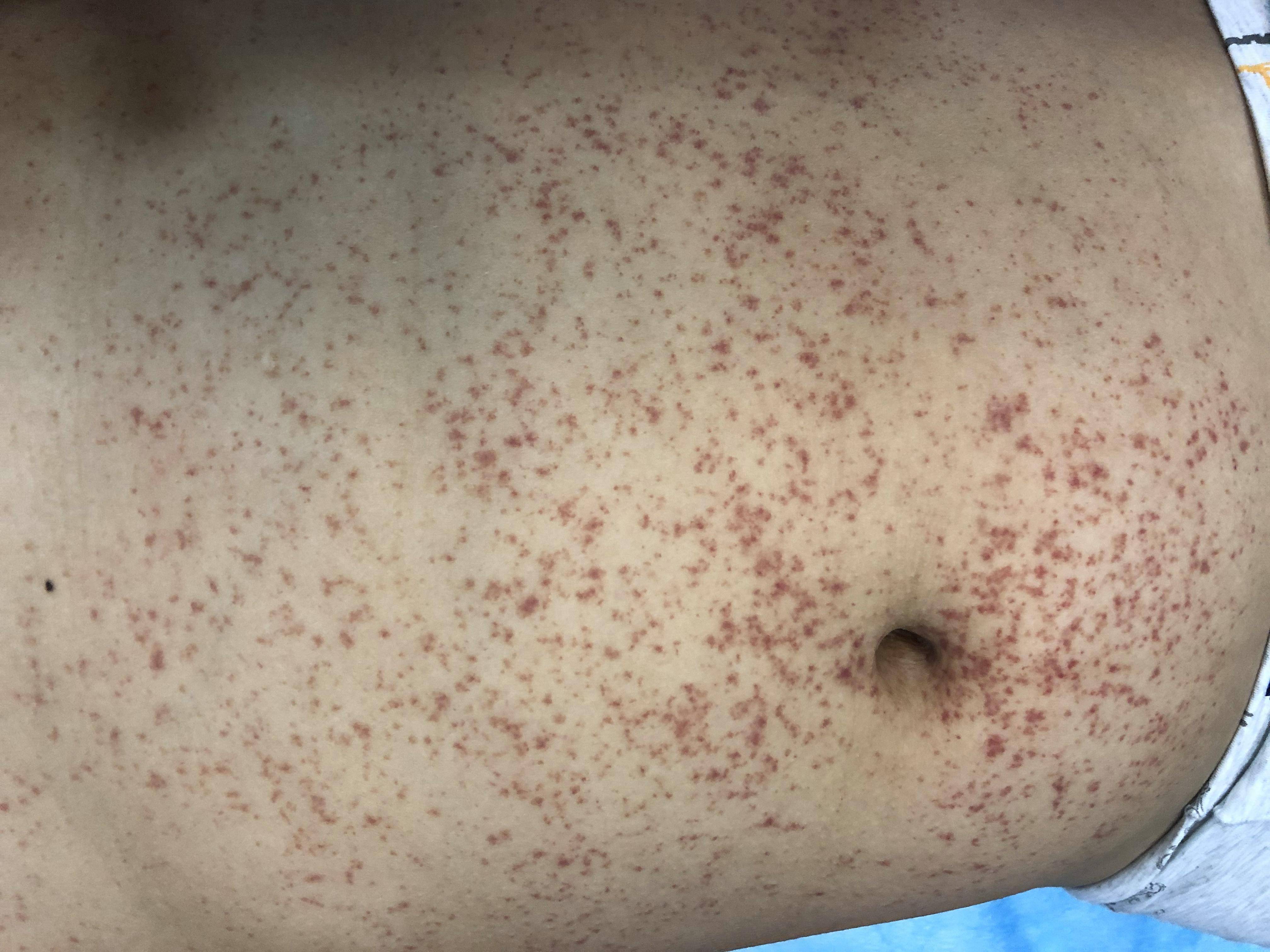 大小|過敏性紫癜腎炎有哪些癥狀？