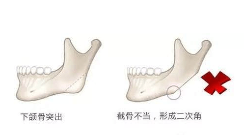 方案|圣嘉新邱立东：下颌角手术常见的失败类型和修复方法