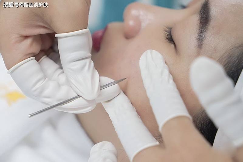 针刺|黑头、闭口、痘痘,要不要做“针清”?