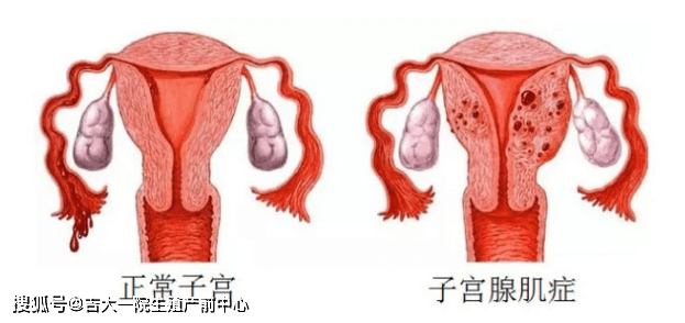 医问到底 什么是子宫内膜异位症 怎么进行处理 卵巢