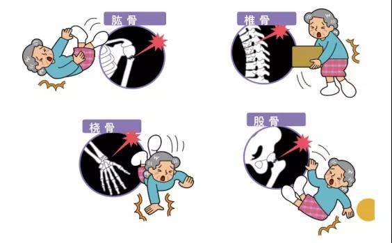 老人|老人经常腰酸背痛，需要做做这项检查