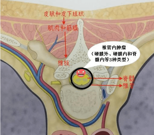 肿瘤|钟情于广场舞的张大妈，因为它，出门只能坐轮椅代步！