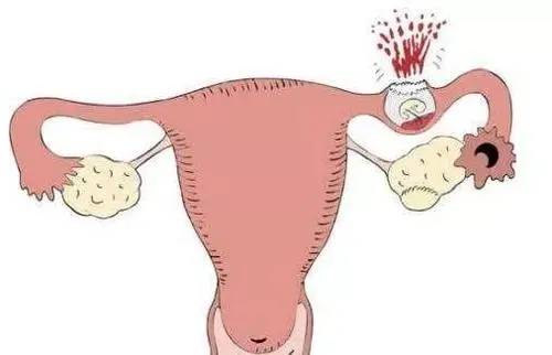 宫外孕图片 早期症状图片