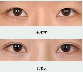 朋友|为了美丽，对自己下手“狠的人”真的很多，达芬奇定制美眼为啥她点名了非要做