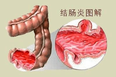今天讲讲关于结肠炎的几个问题