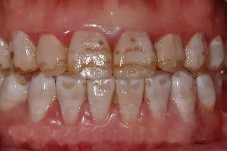 但随着氟斑牙程度加深,牙齿表面可能还会出现黄褐色或暗棕色斑块,以及