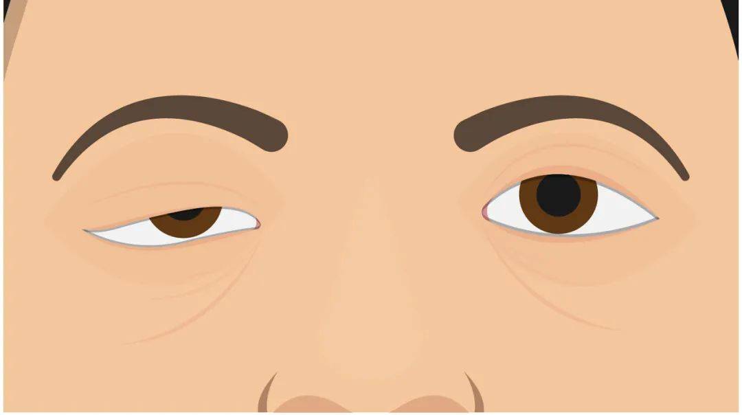 症状|重症肌无力，是肌肉出问题了吗？