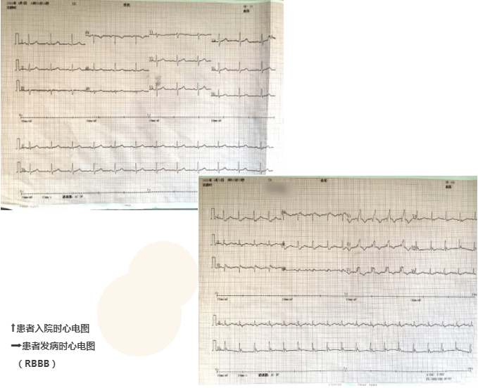 造影|内外联手、绿色通道——救治急性危重型肺栓塞患者