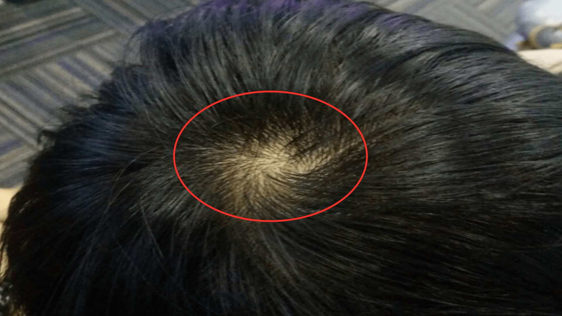 洗頭|堅持每天洗頭會變禿？防止脫發，有4個方法