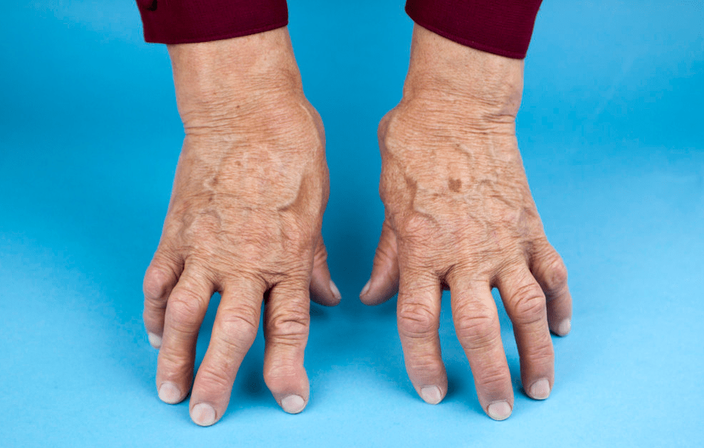 手指关节肿胀,典型的"鹅颈样畸形"类风湿性关节炎的关节僵硬症状早期