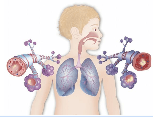 兒童哮喘支氣管哮喘避免用藥惡性循環四個誤區一定要避免