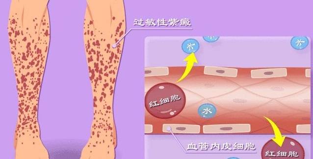 进行|过敏性紫癜有哪些治疗方法?